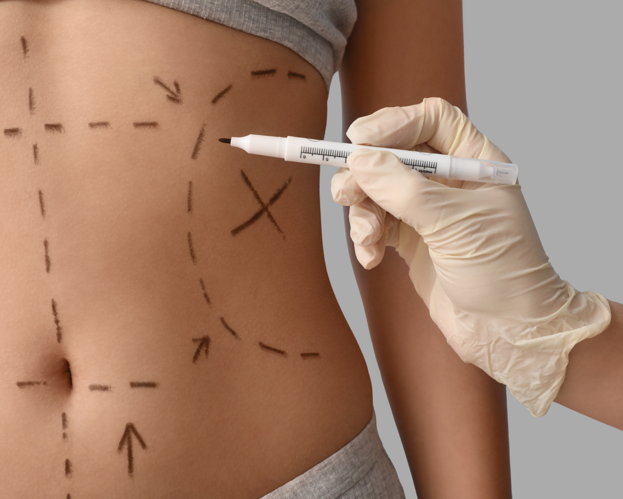 ¿Puedo hacerme una abdominoplastia si no he tenido hijos? Sí, y te contamos por qué