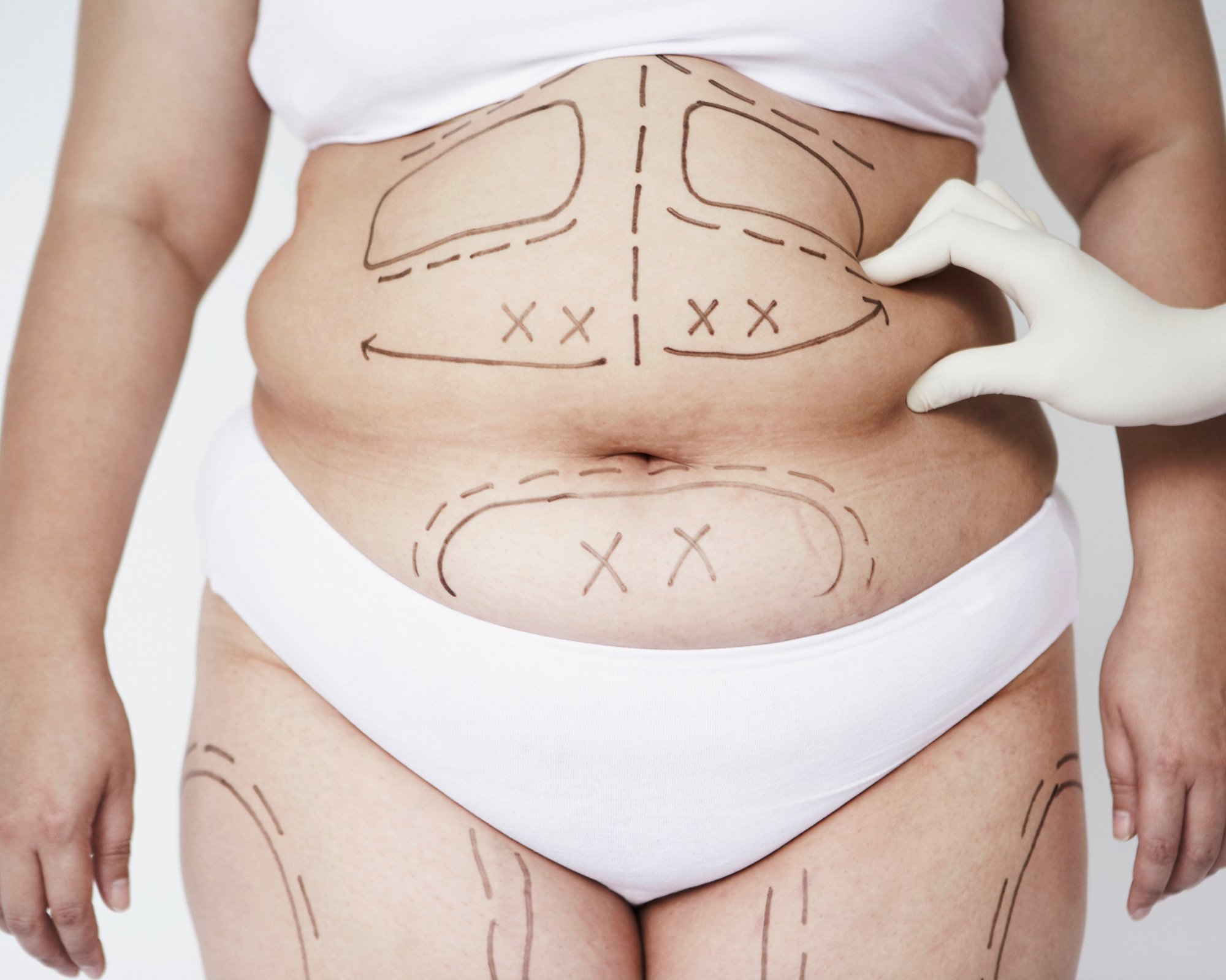 ¿La liposucción es un método para bajar de peso?
