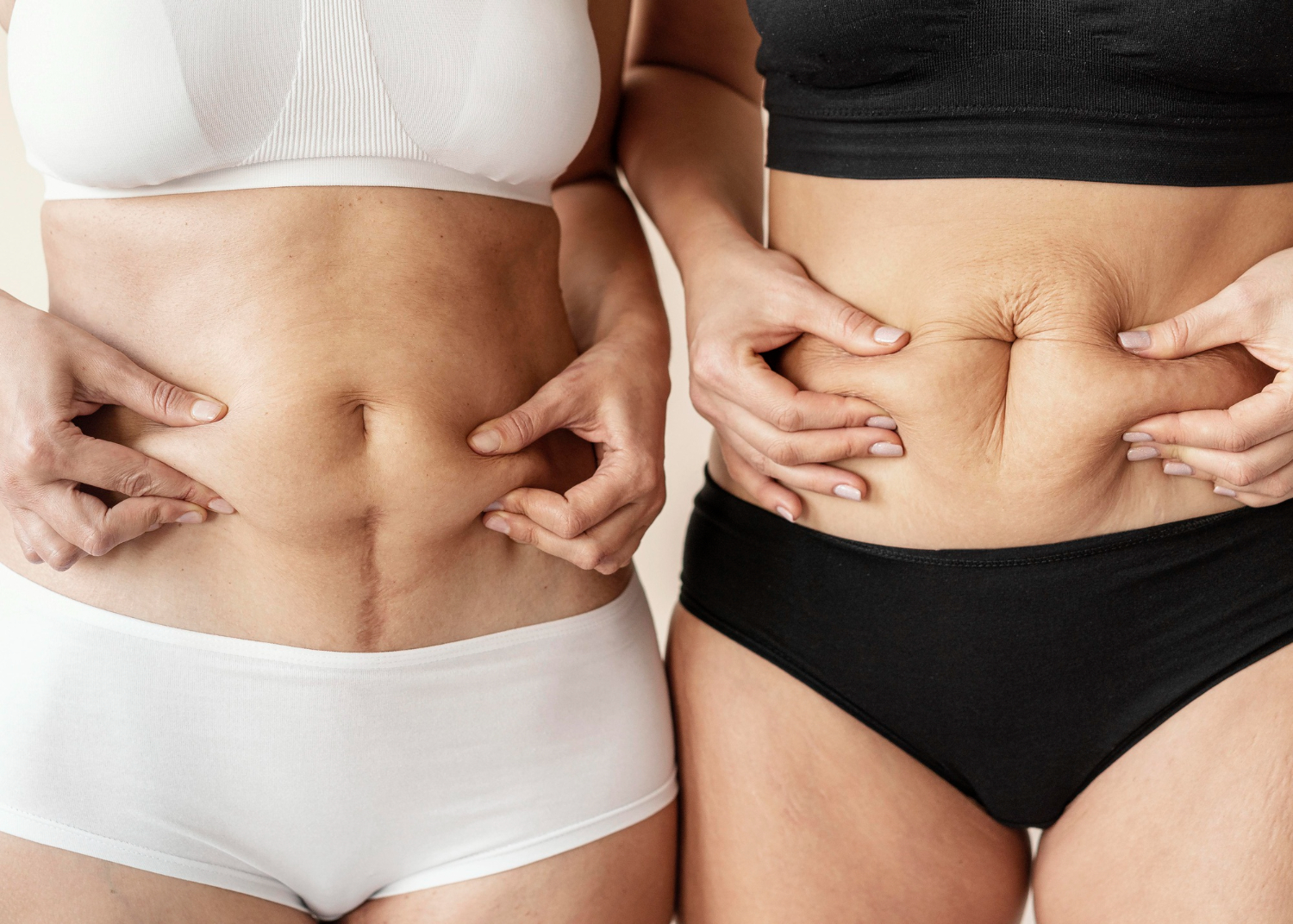 ¿Lipoescultura o abdominoplastia? Guía definitiva para recuperar tu contorno post-parto o post-bariátrica