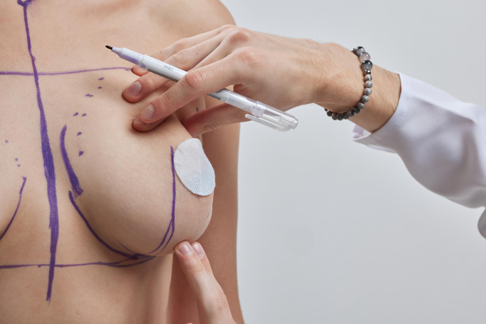 Para el levantamiento de senos, ¿se necesitan implantes?