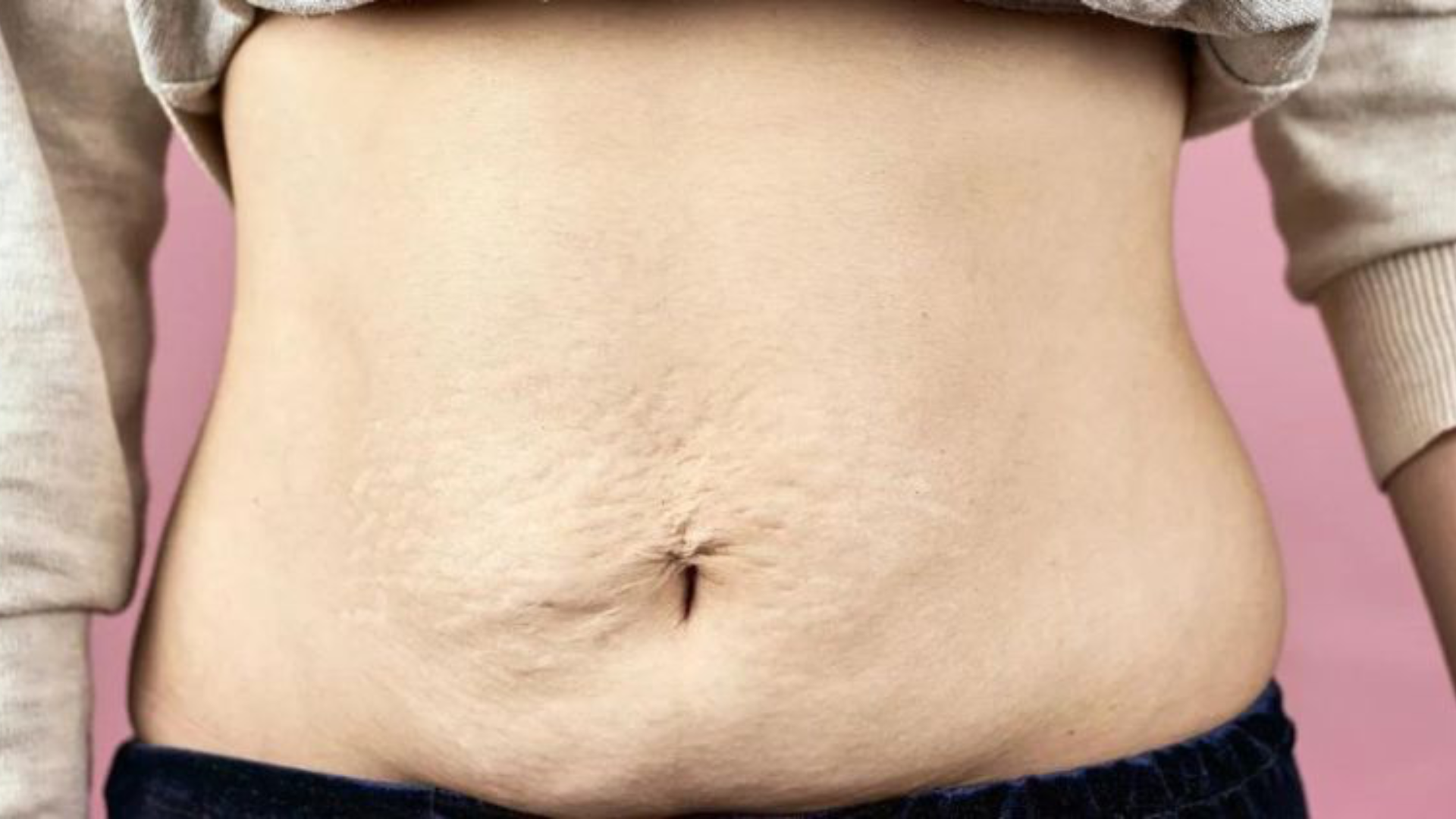 Cómo evitar la fibrosis después de una liposucción: guía posoperatoria