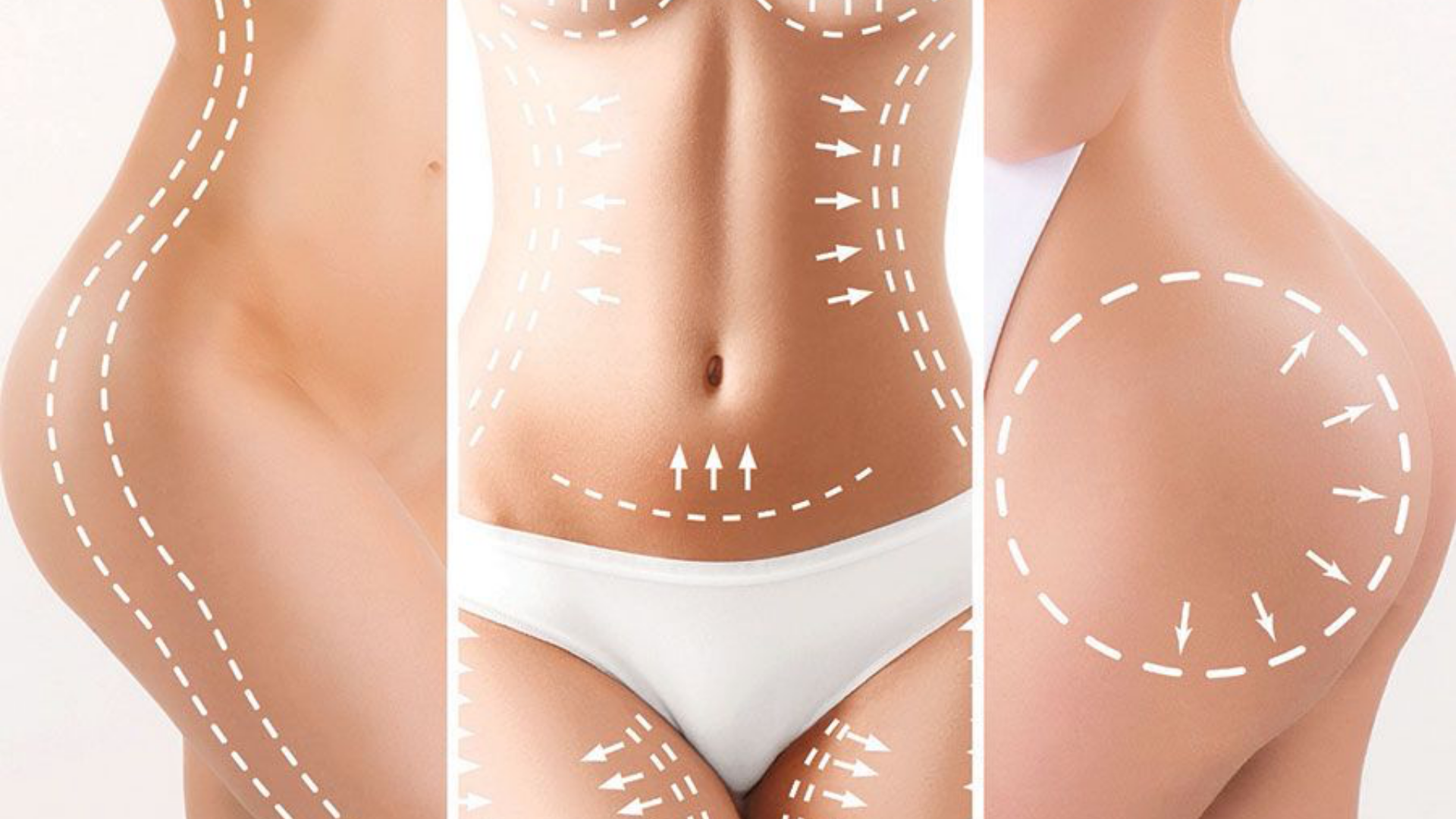 Liposucción VASER: beneficios, resultados y recuperación después de la cirugía