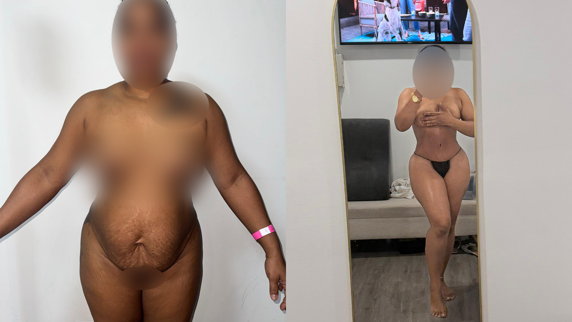 Así transforma tu figura la lipoabdominoplastia