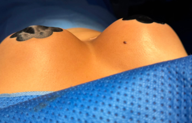 Levantamiento de senos sin implantes: resultados, ventajas y desventajas