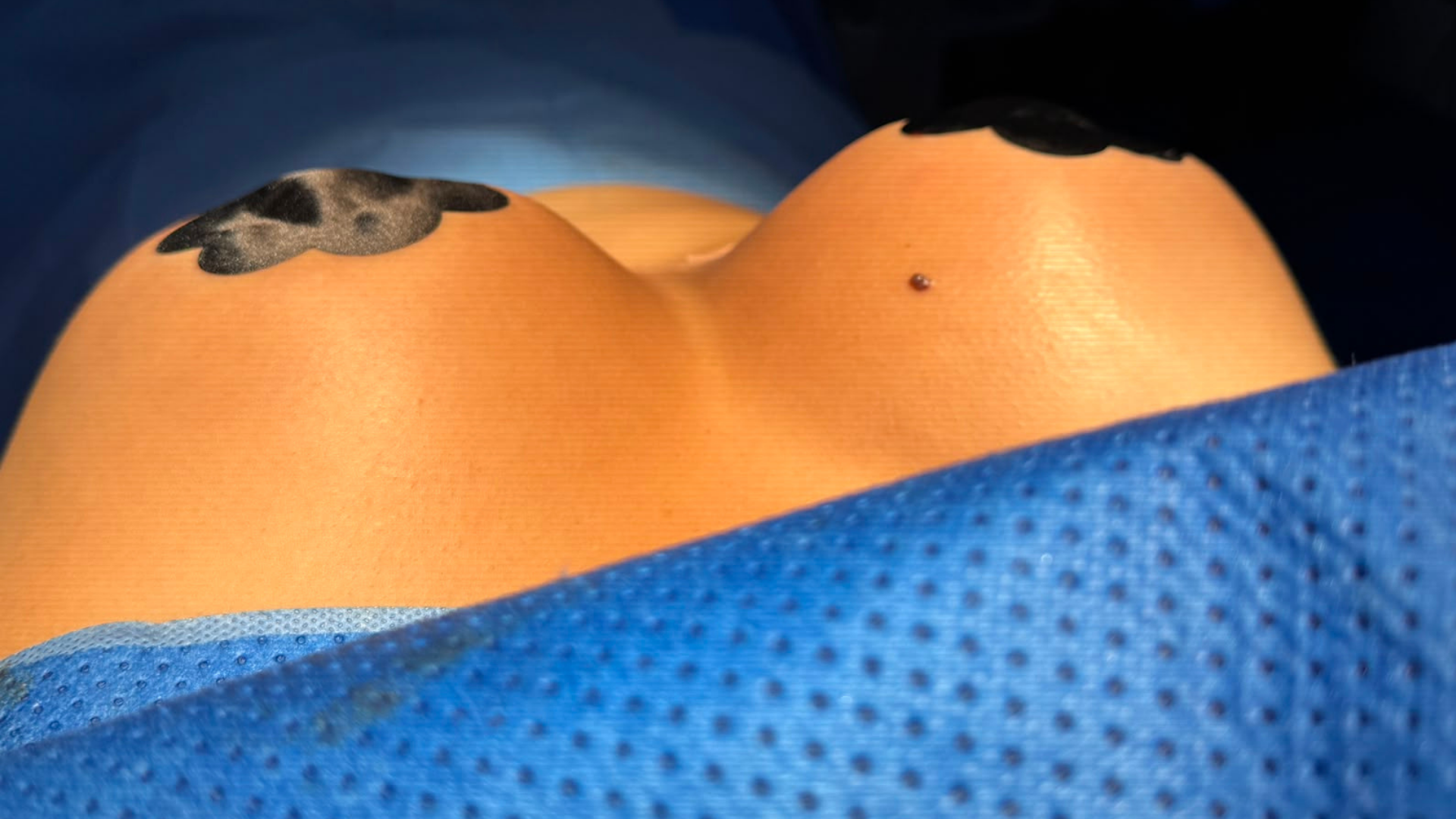 Levantamiento de senos sin implantes: resultados, ventajas y desventajas
